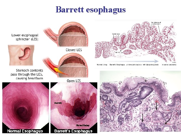 Barrett esophagus 