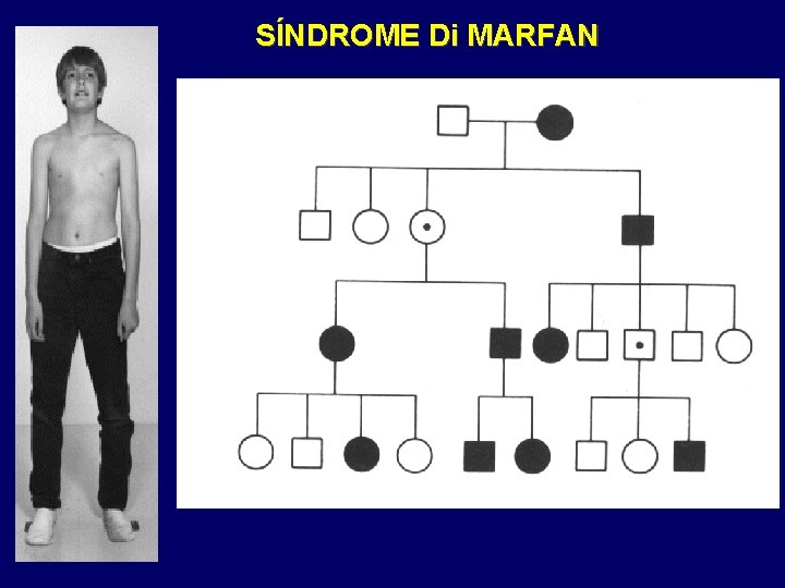 SÍNDROME Di MARFAN 