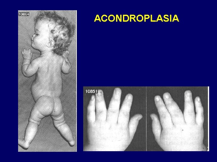 ACONDROPLASIA 