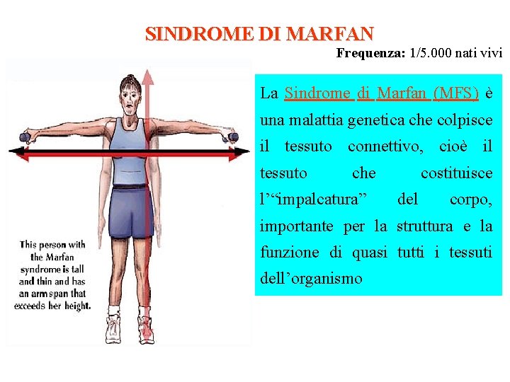 SINDROME DI MARFAN Frequenza: 1/5. 000 nati vivi La Sindrome di Marfan (MFS) è