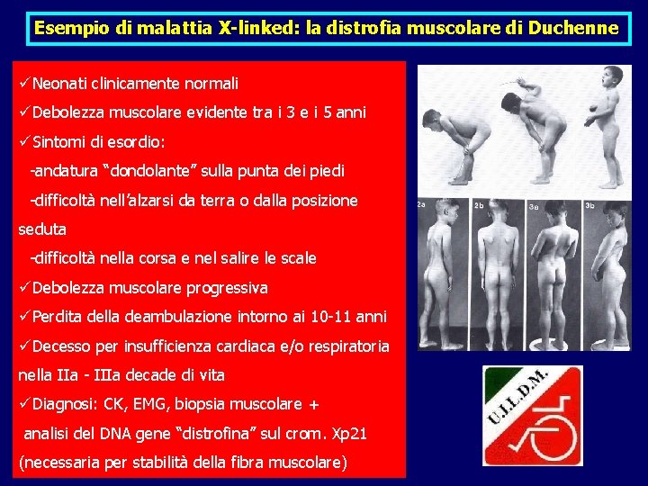 Esempio di malattia X-linked: la distrofia muscolare di Duchenne üNeonati clinicamente normali üDebolezza muscolare