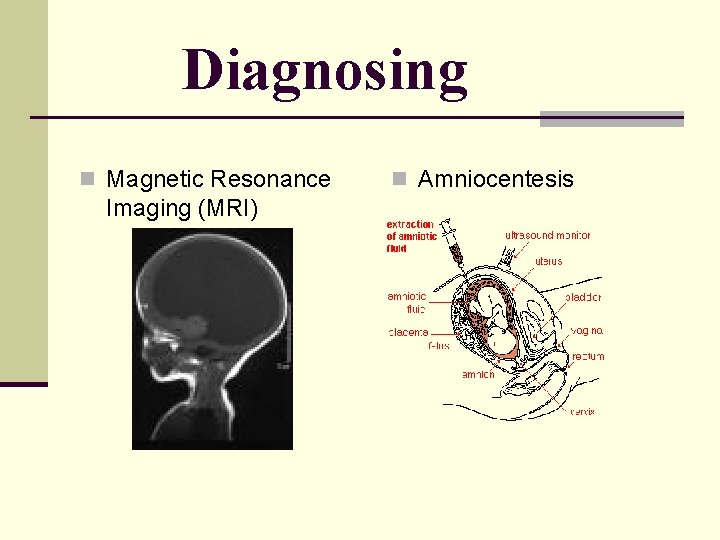 Diagnosing n Magnetic Resonance Imaging (MRI) n Amniocentesis Diagnosing n Magnetic Resonance Imaging (MRI) n Amniocentesis