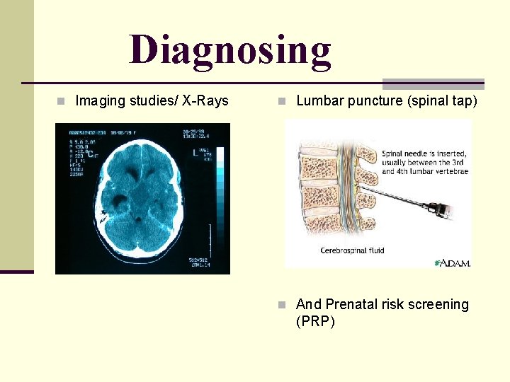 Diagnosing n Imaging studies/ X-Rays n Lumbar puncture (spinal tap) n And Prenatal risk Diagnosing n Imaging studies/ X-Rays n Lumbar puncture (spinal tap) n And Prenatal risk