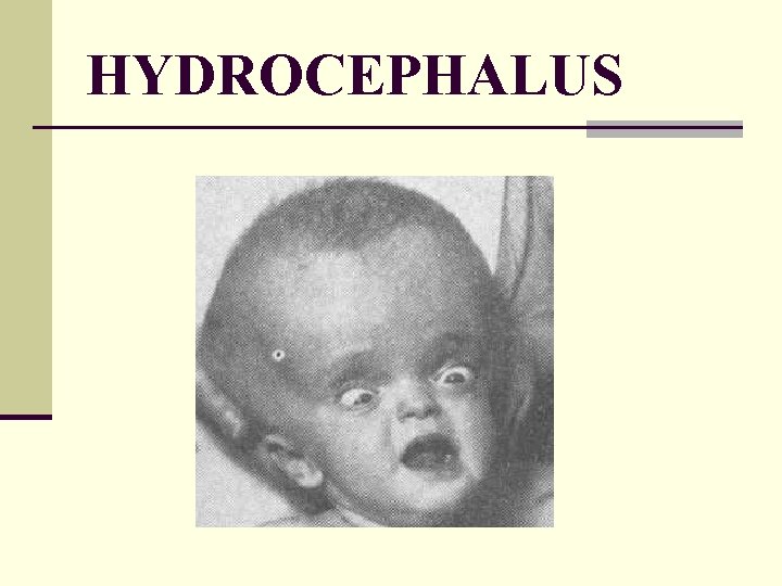 HYDROCEPHALUS 