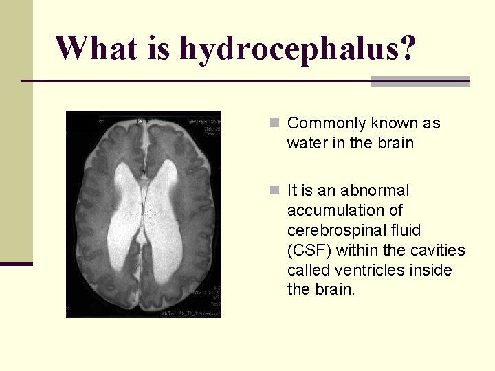 What is hydrocephalus? n Commonly known as water in the brain n It is