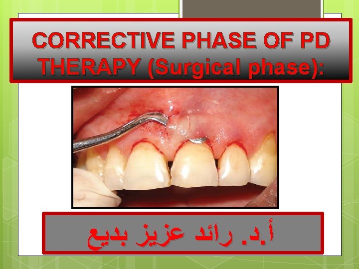 CORRECTIVE PHASE OF PD THERAPY (Surgical phase): ﺭﺍﺋﺪ ﻋﺰﻳﺰ ﺑﺪﻳﻊ. ﺩ. ﺃ 