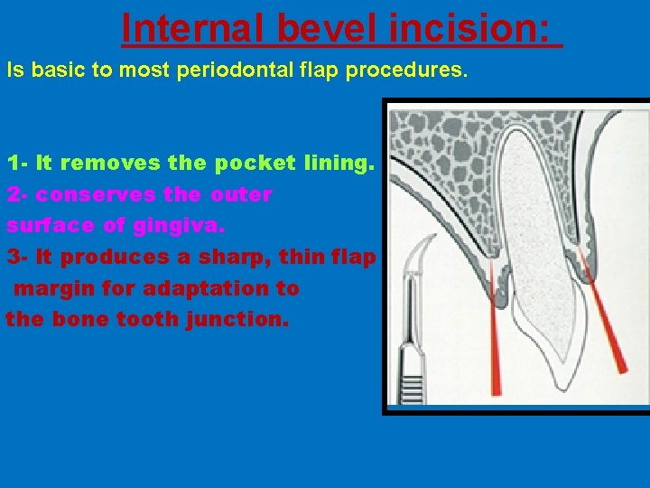 Internal bevel incision: Is basic to most periodontal flap procedures. 1 - It removes