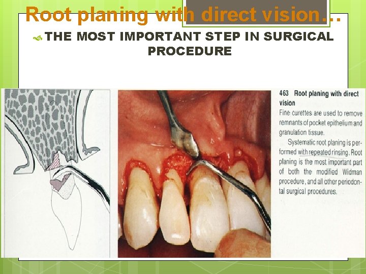 Root planing with direct vision… THE MOST IMPORTANT STEP IN SURGICAL PROCEDURE 5 -Direct