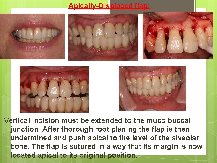 Apically-Displaced flap: Vertical incision must be extended to the muco buccal junction. After thorough