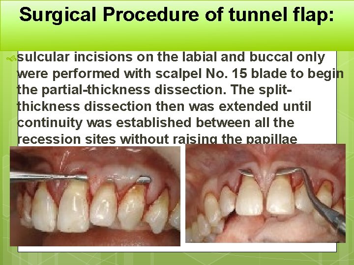 Surgical Procedure of tunnel flap: sulcular incisions on the labial and buccal only were