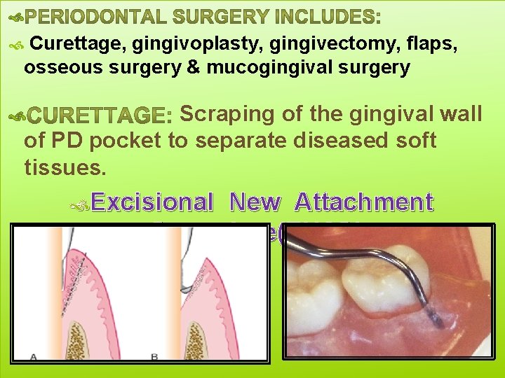  Curettage, gingivoplasty, gingivectomy, flaps, osseous surgery & mucogingival surgery Scraping of the gingival