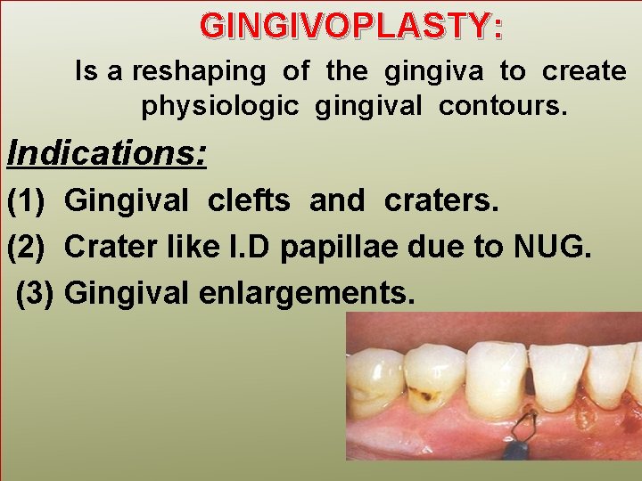 GINGIVOPLASTY: Is a reshaping of the gingiva to create physiologic gingival contours. Indications: (1)