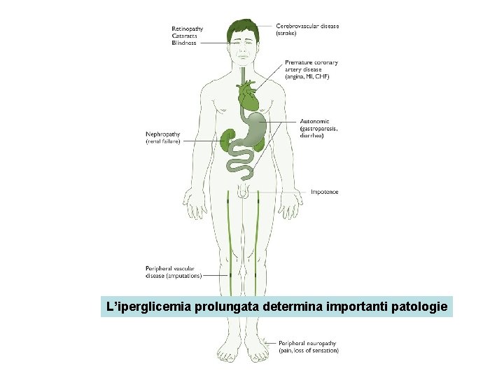 L’iperglicemia prolungata determina importanti patologie 
