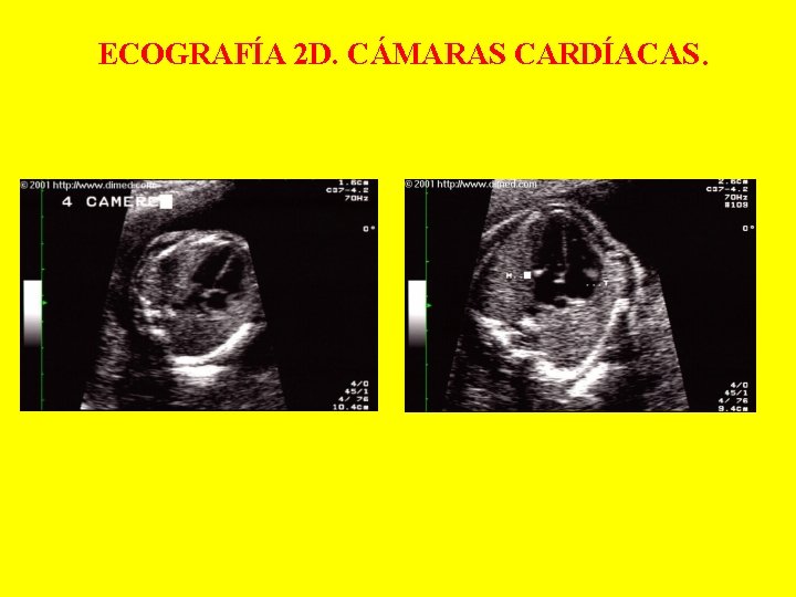 ECOGRAFÍA 2 D. CÁMARAS CARDÍACAS. 