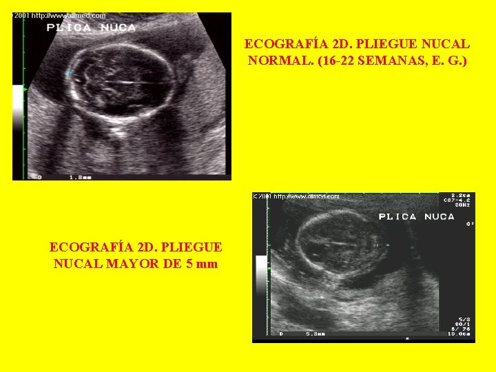 ECOGRAFÍA 2 D. PLIEGUE NUCAL NORMAL. (16 -22 SEMANAS, E. G. ) ECOGRAFÍA 2