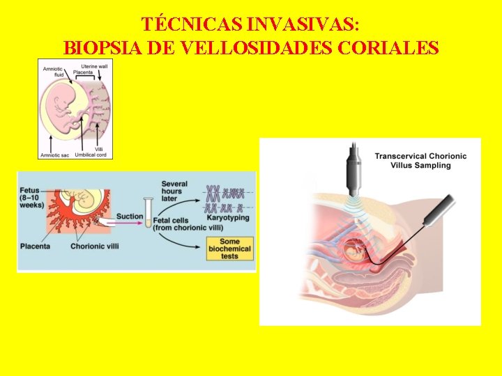 TÉCNICAS INVASIVAS: BIOPSIA DE VELLOSIDADES CORIALES 