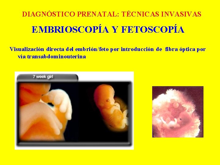 DIAGNÓSTICO PRENATAL: TÉCNICAS INVASIVAS EMBRIOSCOPÍA Y FETOSCOPÍA Visualización directa del embrión/feto por introducción de