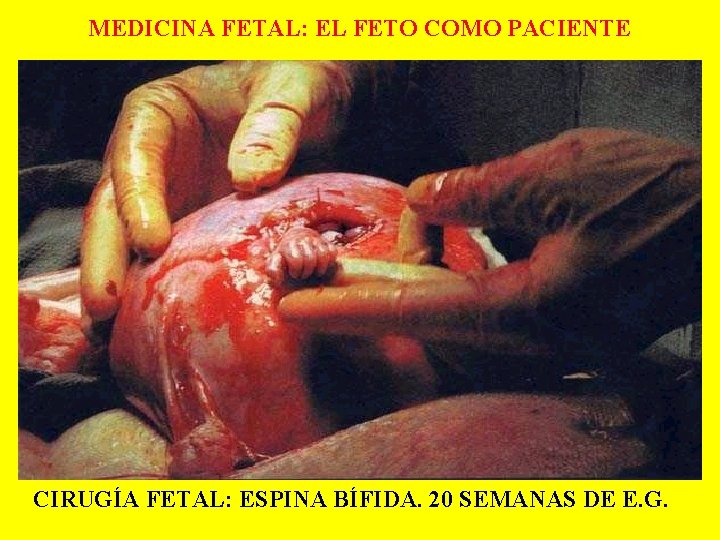 MEDICINA FETAL: EL FETO COMO PACIENTE CIRUGÍA FETAL: ESPINA BÍFIDA. 20 SEMANAS DE E.