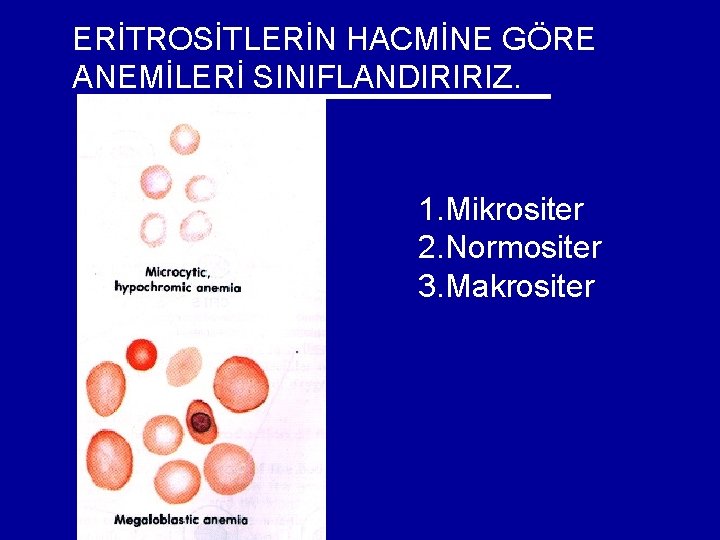 ERİTROSİTLERİN HACMİNE GÖRE ANEMİLERİ SINIFLANDIRIRIZ. 1. Mikrositer 2. Normositer 3. Makrositer ERİTROSİTLERİN HACMİNE GÖRE ANEMİLERİ SINIFLANDIRIRIZ. 1. Mikrositer 2. Normositer 3. Makrositer