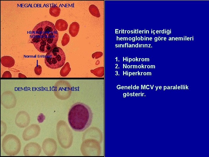 MEGALOBLASTİK ANEMİ HİPERSEGMENTE NÖTROFİLLER Normal Eritrosit DEMİR EKSİKLİĞİ ANEMİSİ Eritrositlerin hacmine göre anemileri sınıflandırırız. MEGALOBLASTİK ANEMİ HİPERSEGMENTE NÖTROFİLLER Normal Eritrosit DEMİR EKSİKLİĞİ ANEMİSİ Eritrositlerin hacmine göre anemileri sınıflandırırız.
