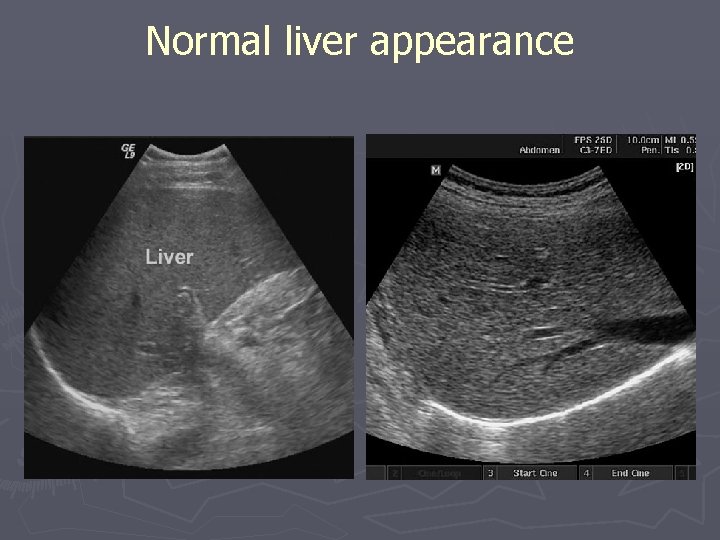 Normal liver appearance 