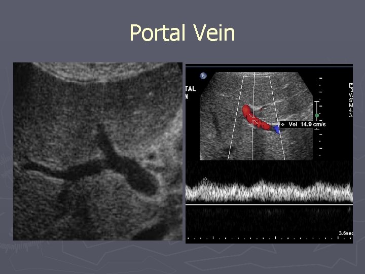 Portal Vein 