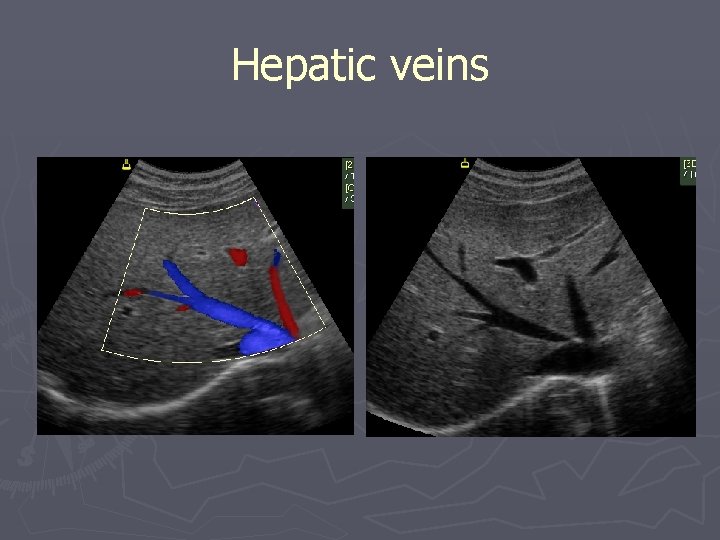 Hepatic veins 