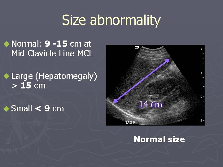 Size abnormality u Normal: 9 -15 cm at Mid Clavicle Line MCL u Large