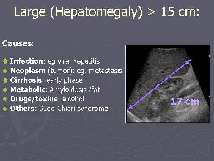 Large (Hepatomegaly) > 15 cm: Causes: Infection: eg viral hepatitis u Neoplasm (tumor): eg.