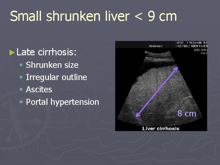 Small shrunken liver < 9 cm ► Late cirrhosis: § Shrunken size § Irregular