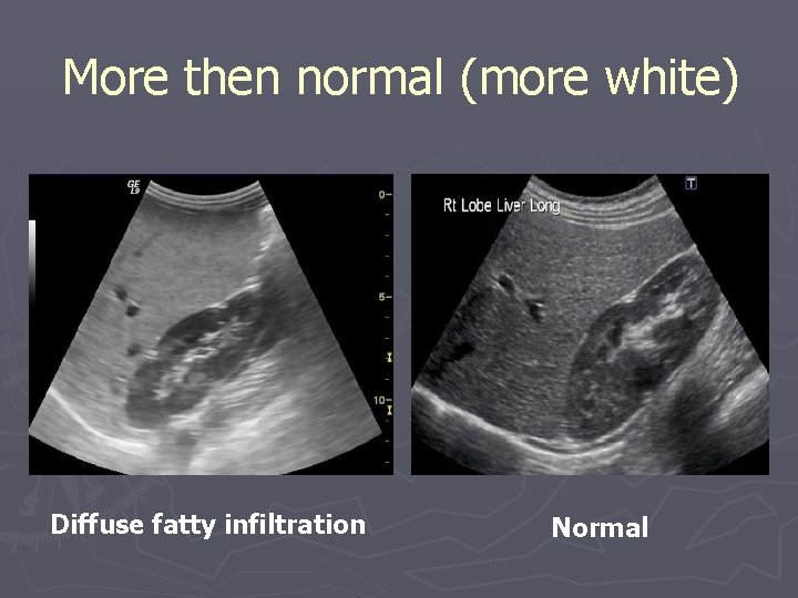 More then normal (more white) Diffuse fatty infiltration Normal 