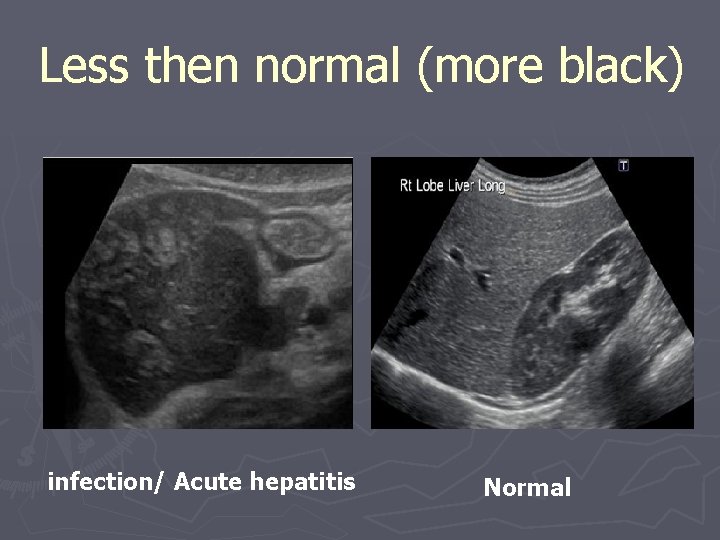 Less then normal (more black) infection/ Acute hepatitis Normal 