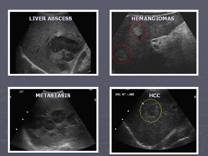 LIVER ABSCESS METASTASIS HEMANGIOMAS HCC 