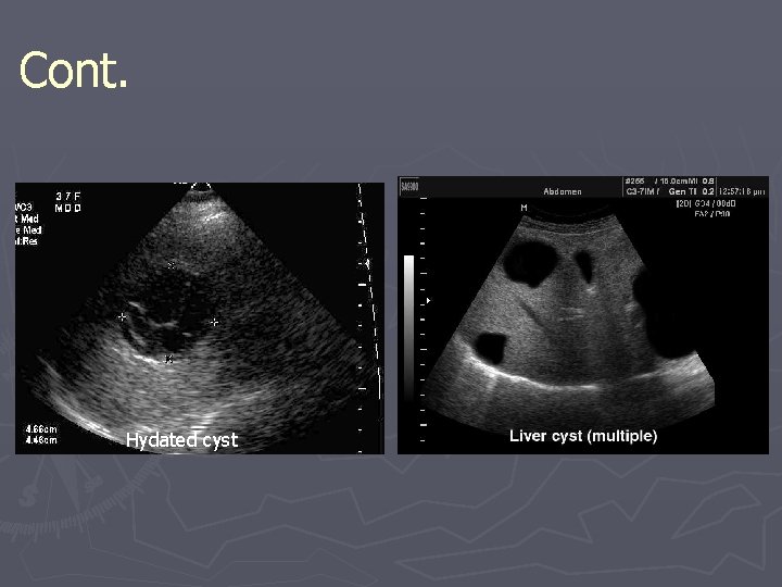 Cont. Hydated cyst 