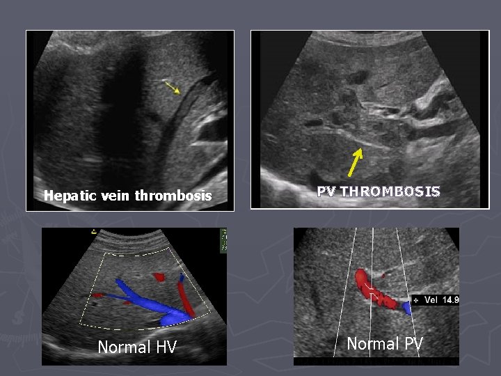 Hepatic vein thrombosis Normal HV PV THROMBOSIS Normal PV 