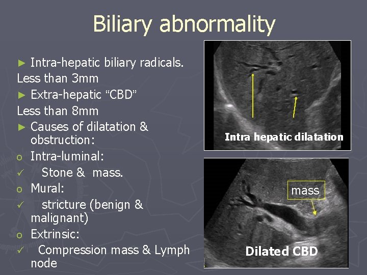 Biliary abnormality Intra-hepatic biliary radicals. Less than 3 mm ► Extra-hepatic “CBD” Less than
