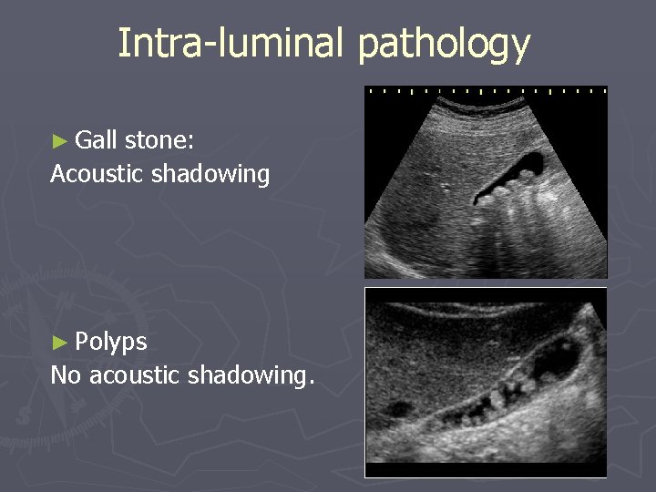 Intra-luminal pathology ► Gall stone: Acoustic shadowing ► Polyps No acoustic shadowing. 