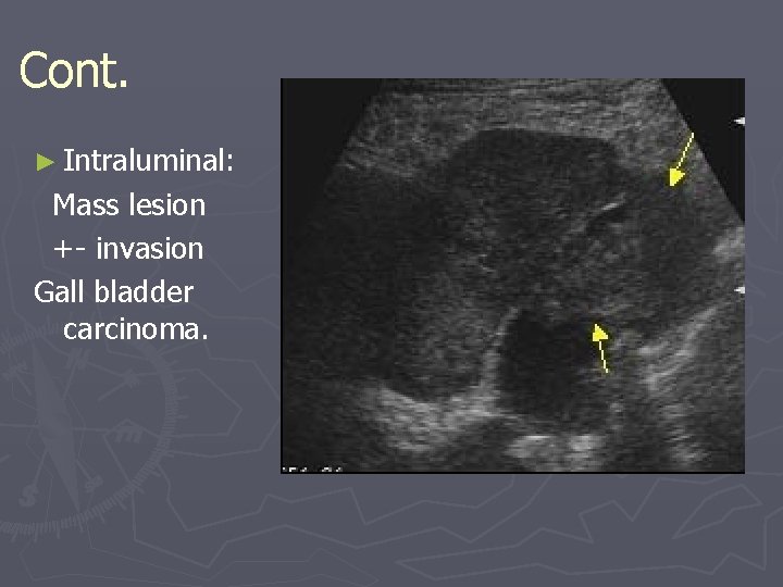 Cont. ► Intraluminal: Mass lesion +- invasion Gall bladder carcinoma. 