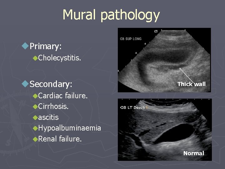 Mural pathology u. Primary: u. Cholecystitis. u. Secondary: Thick wall u. Cardiac failure. u.