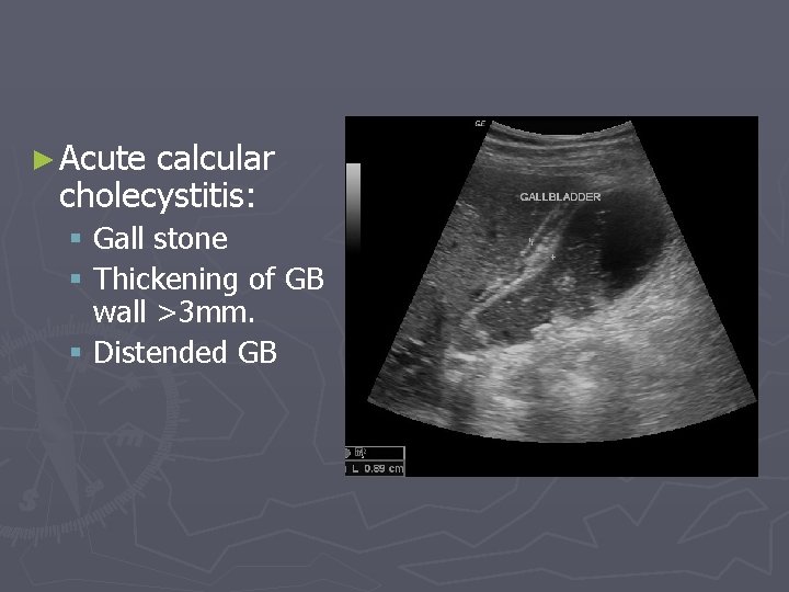 ► Acute calcular cholecystitis: § Gall stone § Thickening of GB wall >3 mm.