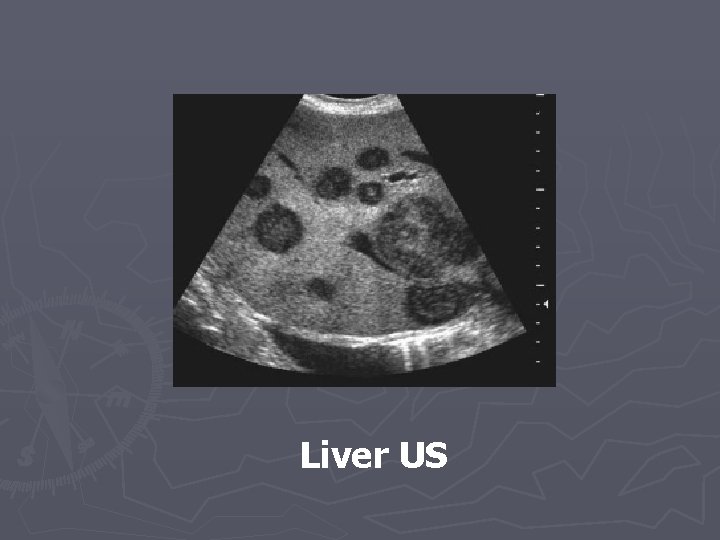 Liver US 