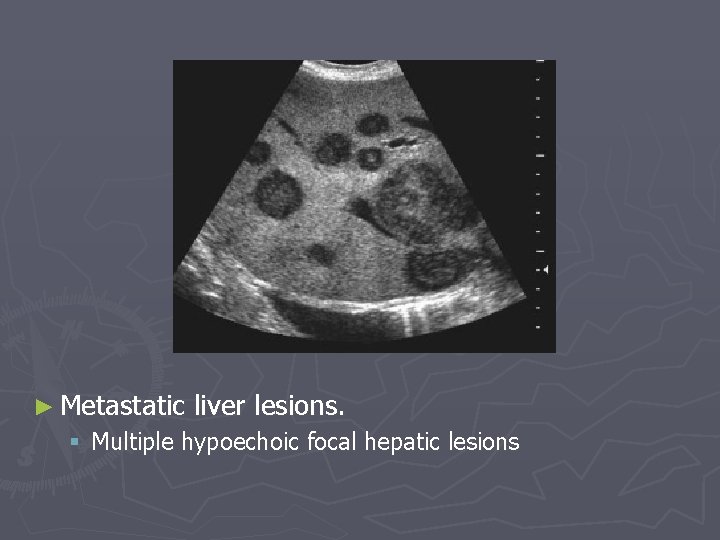 ► Metastatic liver lesions. § Multiple hypoechoic focal hepatic lesions 