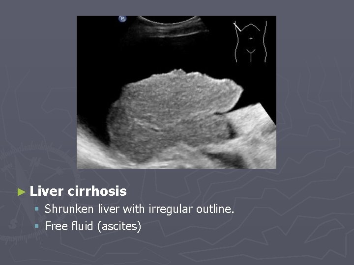 ► Liver cirrhosis § Shrunken liver with irregular outline. § Free fluid (ascites) 