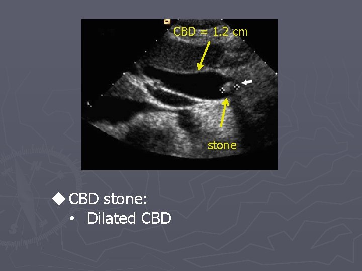 CBD = 1. 2 cm stone u CBD stone: • Dilated CBD 