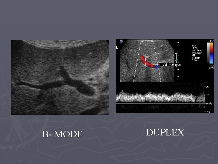 B- MODE DUPLEX 