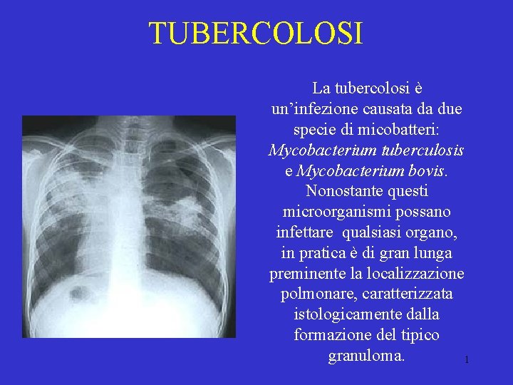 TUBERCOLOSI La tubercolosi è un’infezione causata da due specie di micobatteri: Mycobacterium tuberculosis e