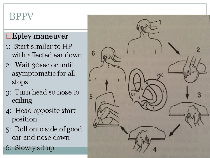 BPPV �Epley maneuver 1: Start similar to HP with affected ear down. 2: Wait BPPV �Epley maneuver 1: Start similar to HP with affected ear down. 2: Wait