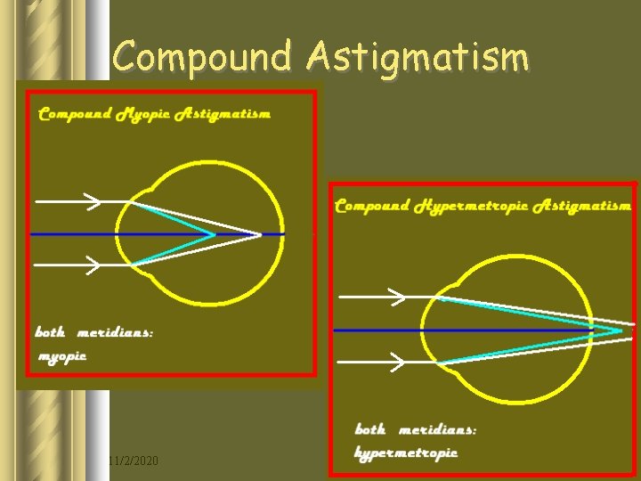 Compound Astigmatism 11/2/2020 15 