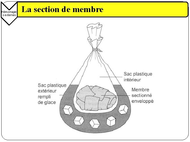 Hémorragie s externes La section de membre 