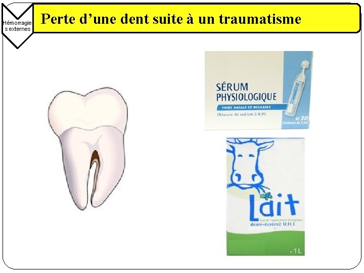 Hémorragie s externes Perte d’une dent suite à un traumatisme 
